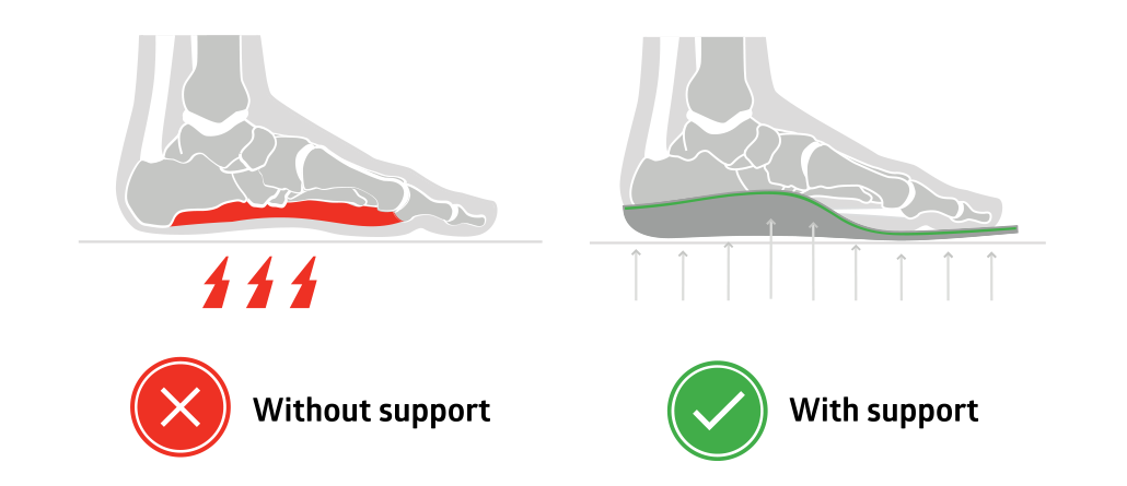 Image of leg with support and without support of a orthotic device