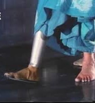 Sudha's leg image